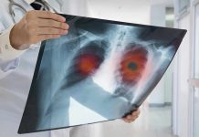 Doctor holding lung X-ray with highlighted areas.